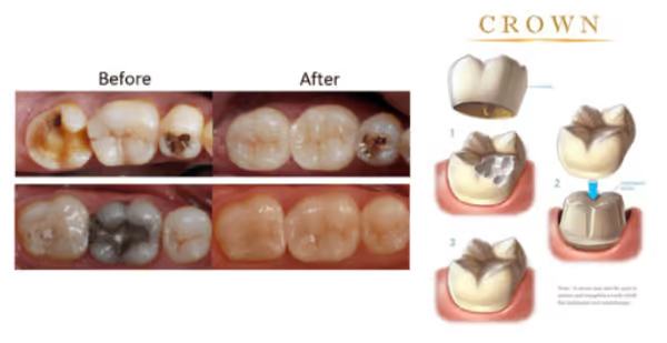Grandview Dental Clinic | Tooth Extraction, Root Canal and Dental Crown