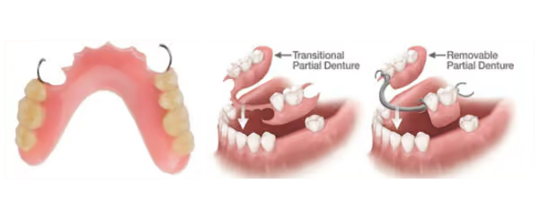 Grandview Dental Clinic | Mouthguard, Dentures and Invisalign Or Clear Aligners