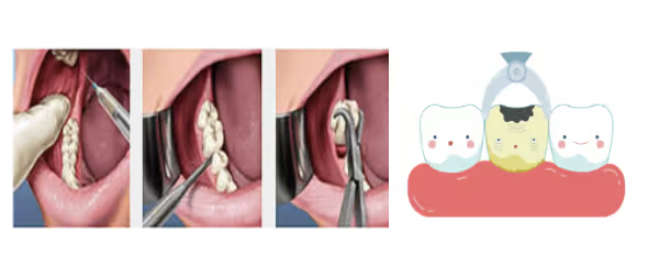 Grandview Dental Clinic | Mouthguard, Nightguard and Invisalign