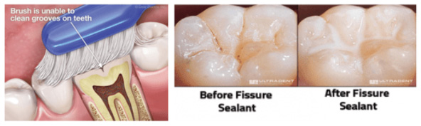 Grandview Dental Clinic | Root Canal, Dentures and Dental Crown