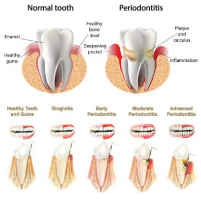 Grandview Dental Clinic | Dental Bridges, Dental Crown and Gum Diseases