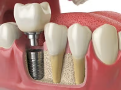 Grandview Dental Clinic | Dental Implants, Mouthguard and Nightguard