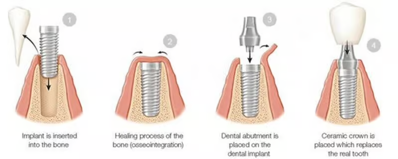 Grandview Dental Clinic | Root Canal, Dentures and Dental Implants