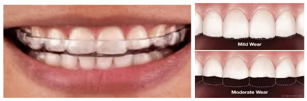 Grandview Dental Clinic | Gum Diseases, Root Canal and Dentures