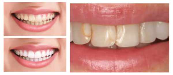 Grandview Dental Clinic | Dental Implants, Mouthguard and Dental Fillings