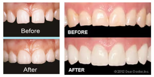 Grandview Dental Clinic | Mouthguard, Invisalign Or Clear Aligners and Dentures