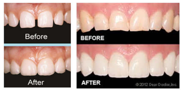 comparison of teeth before- after-Dental veneer