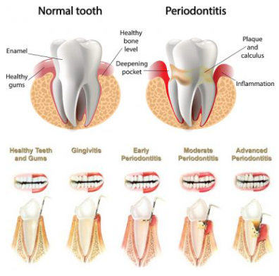 Normal Teeth and Periodontitis