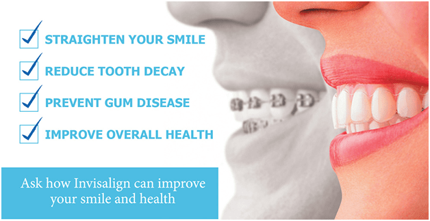 How Invisalign can improve your smile and health